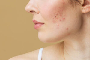 acne treatment in andover blog post