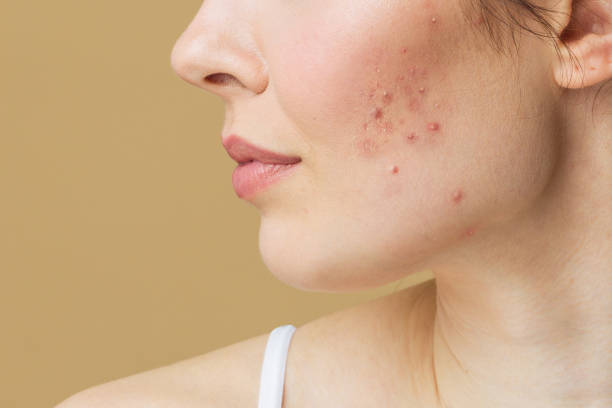 acne treatment in andover blog post